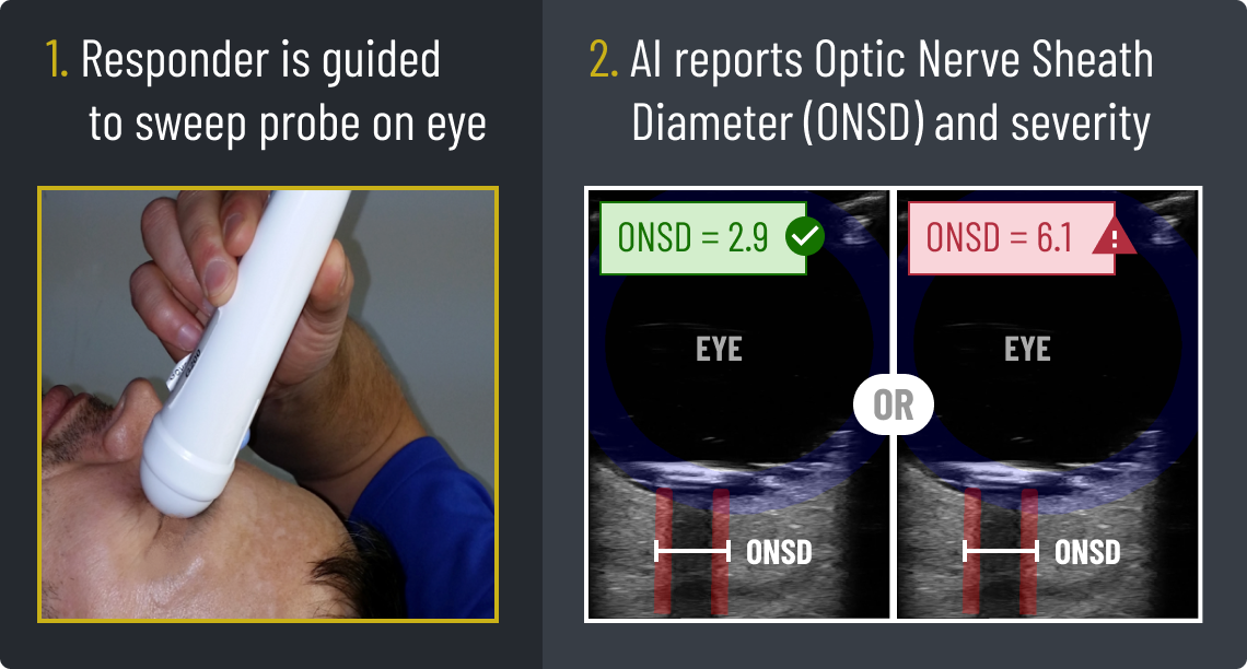 1. Responder is guided to sweep probe on eye. 2. AI reports Optic Nerve Sheath Diameter (ONSD) and severity