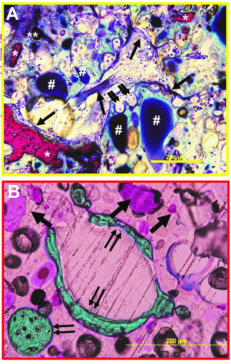 Figures A & B indicating bone regeneration after 4. 12 and 18 months.