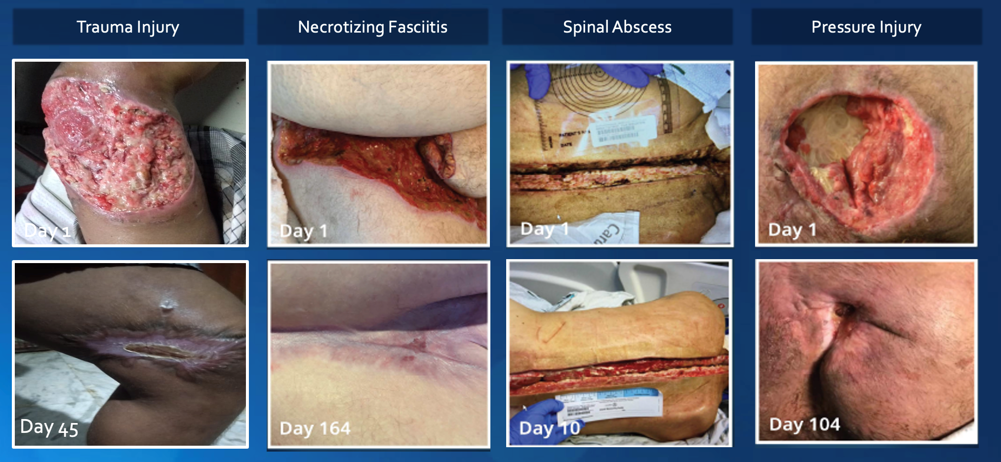 Fig 2: Illustrative Clinical Experiences with Altrazeal Treatment of Traumatic, Surgical and Chronic Wounds