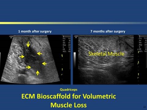 MRI image of a bioscaffold/surgical mesh composed of porcine dermal ECM (XenMatrix™)